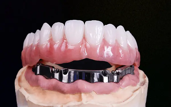Implant Bar