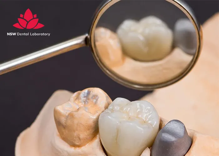 Helpful-Things-to Know-About-Crowns on-A-Tooth