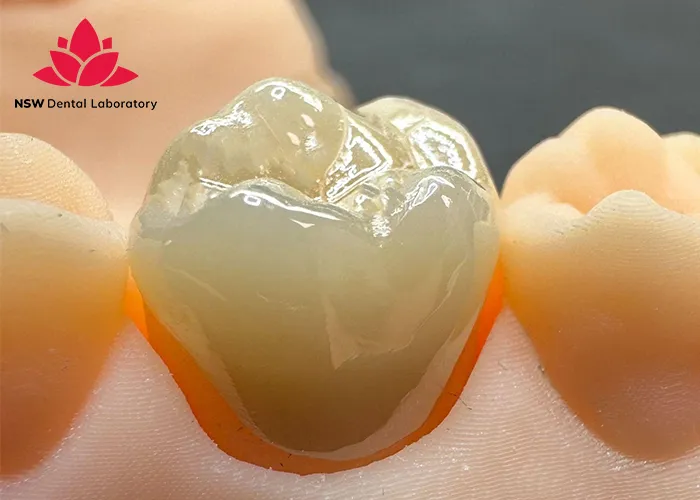 Which-Material-Is-The-Best-For-The-Crown-On-A-Molar?