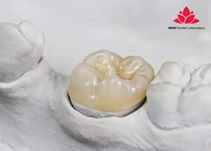 Which-Material-Is-The-Best-For-The-Crown-On-A-Molar?