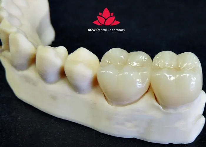 Best-types-of-dental-crown-material