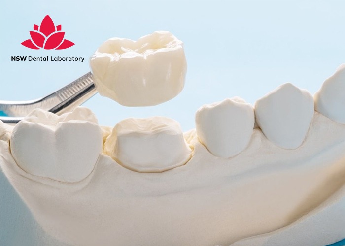 A Detailed Dental Crown Procedure: Helpful Things You Should Know