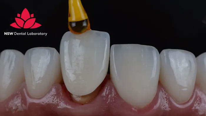 The Most Critical Cases Where Dental Crown Replacement Is Necessary