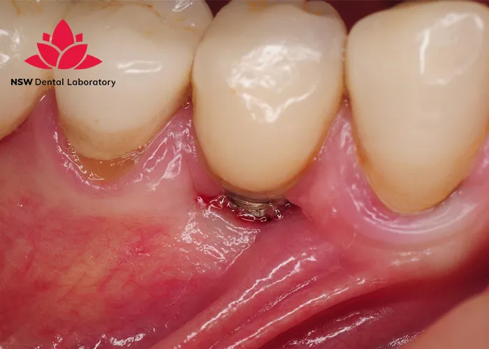 The Most Critical Cases That Require Dental Crown Replacement