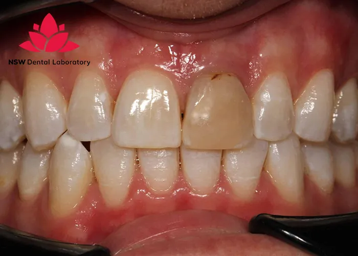 The Most Critical Cases Where Dental Crown Replacement Is Necessary