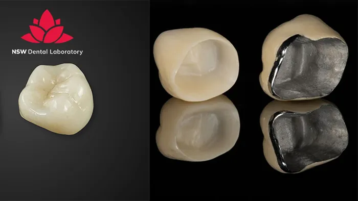 PFM Crowns Vs Zirconia Crowns: The Best Choice For You