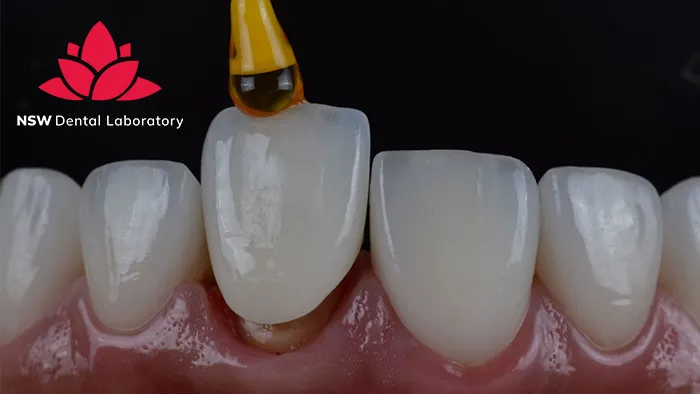 Discover Why Placing A Front Tooth Crown Is More Challenging