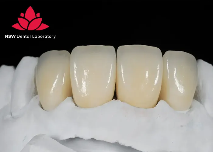 Discover-Why-Placing-A-Front-Tooth-Crown-Is-More-Challenging