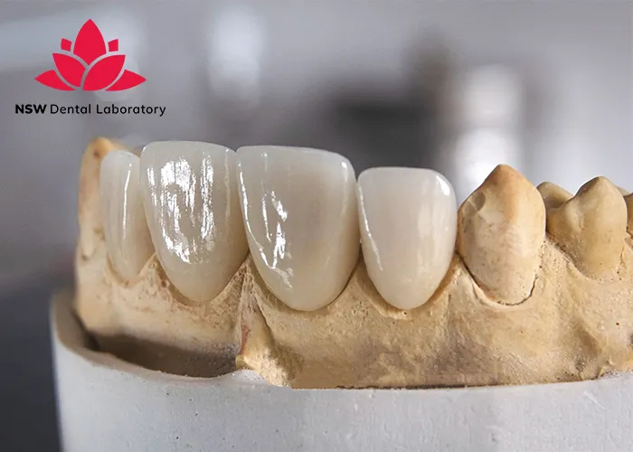 Discover-Why-Placing-A-Front-Tooth-Crown-Is-More-Challenging