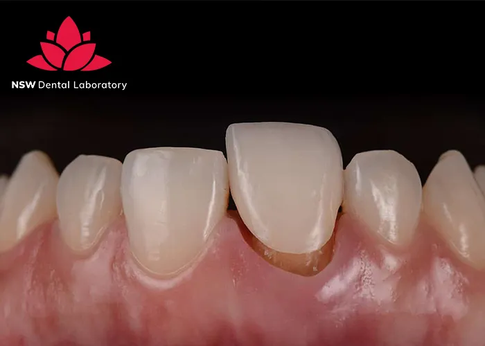 Discover-Why-Placing-A-Front-Tooth-Crown-Is-More-Challenging