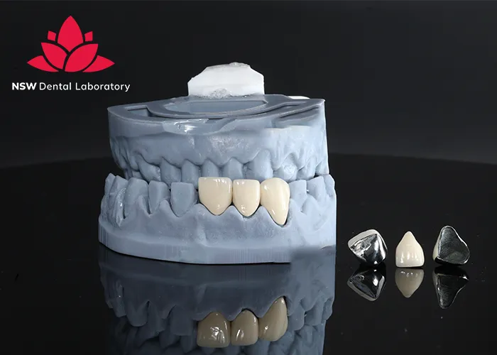 PFM Crowns Vs Zirconia Crowns: The Best Choice For You