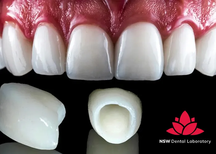 A-Comprehensive-Guide-To-Different-Types-Of-Dental-Crowns