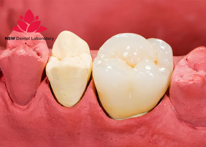 Improved-Your-Smile-With-Dental-Crown-NSW