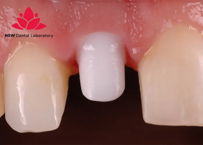 Comprehensive-Guidelines-On-Anterior-Crown-Preparation