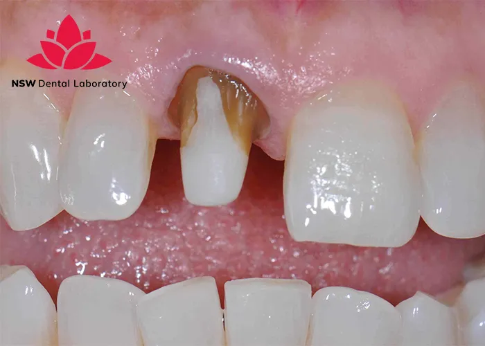 Comprehensive-Guidelines-On-Anterior-Crown-Preparation