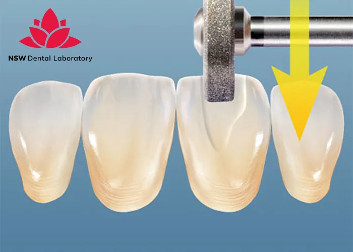 Comprehensive-Guidelines-On-Anterior-Crown-Preparation