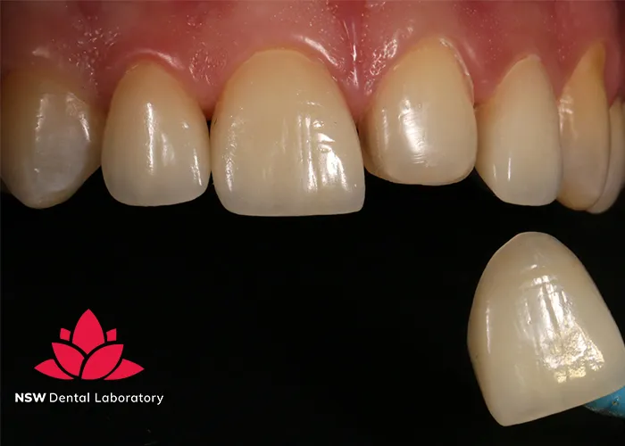 Comprehensive-Guidelines-On-Anterior-Crown-Preparation