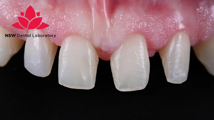 Comprehensive Guidelines On Anterior Crown Preparation