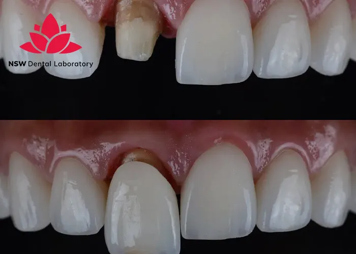 Comprehensive-Guidelines-On-Anterior-Crown-Preparation