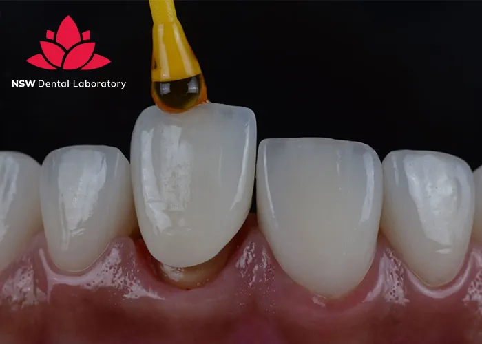 Anterior-Crowns-Done-Right-The-Ultimate-Step-by-Step-Guide