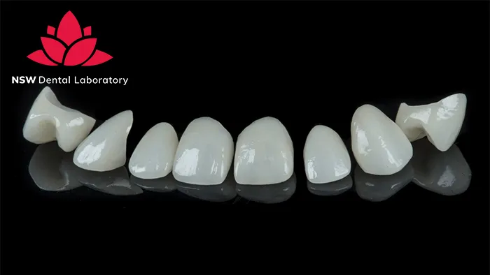 Anterior Crowns Done Right: The Ultimate Step-by-Step Guide
