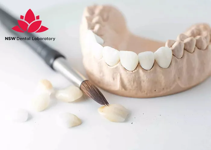 Comprehensive-Comparison-Between-Veneers-And-Crowns