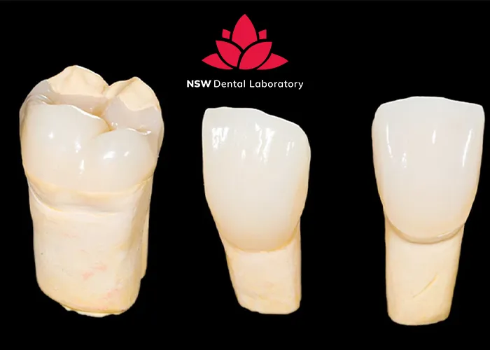 Comprehensive-Comparison-Between-Veneers-And-Crowns