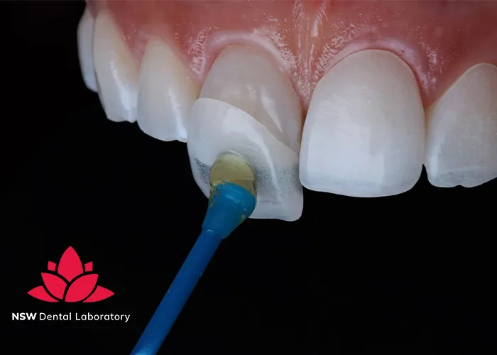 Comprehensive-Comparison-Between-Veneers-And-Crowns