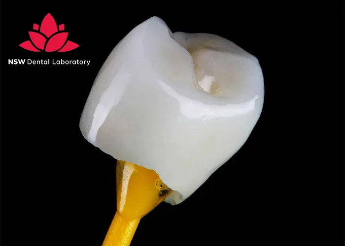 Comprehensive-Comparison-Between-Veneers-And-Crowns
