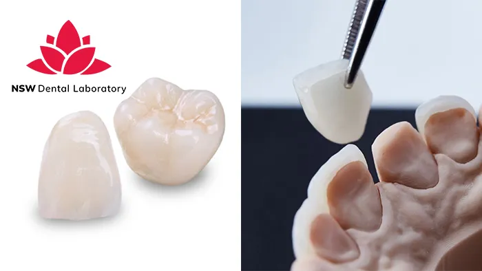 Comprehensive Comparison Between Veneers And Crowns