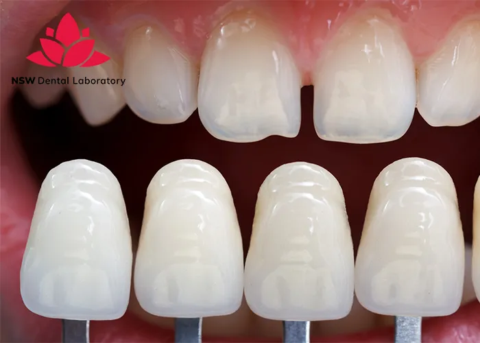 Comprehensive-Comparison-Between-Veneers-And-Crowns