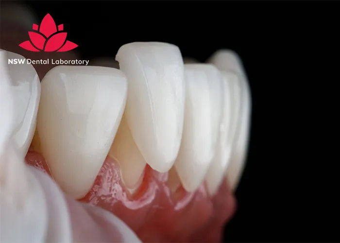 Comprehensive-Comparison-Between-Veneers-And-Crowns