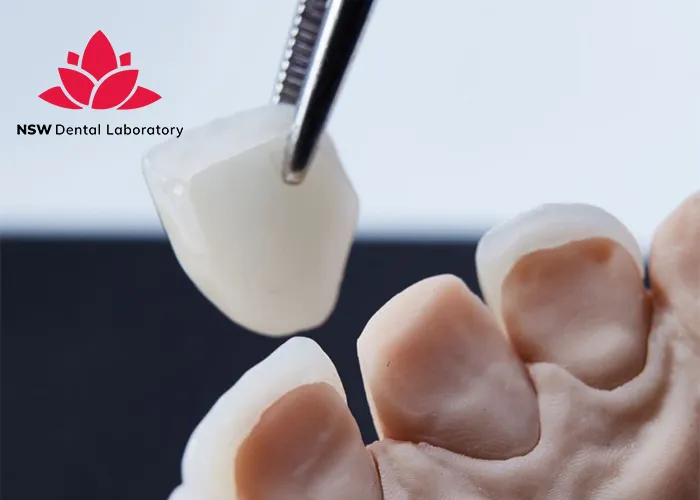 Comprehensive-Comparison-Between-Veneers-And-Crowns