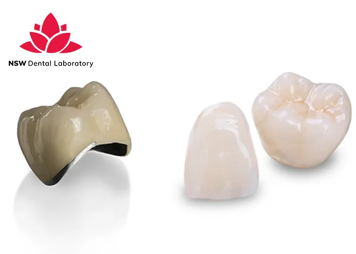Comprehensive-Comparison-Between-Veneers-And-Crowns