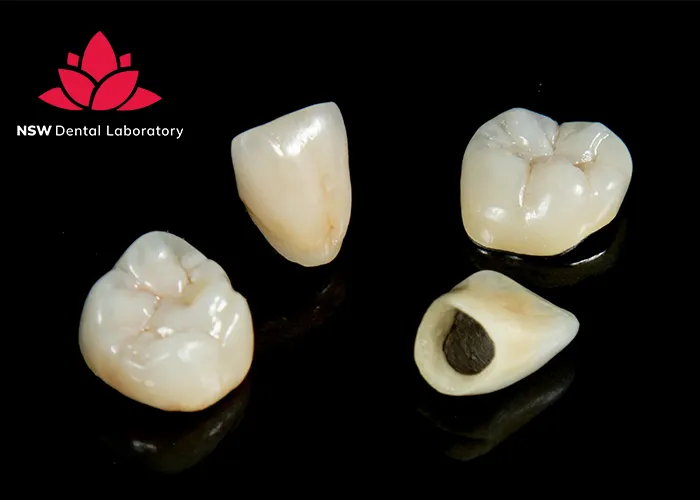 Comprehensive-Comparison-Between-Veneers-And-Crowns