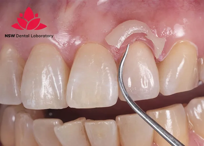 How-To-Achieve-Success-In-Cementing-Zirconia-Crowns?