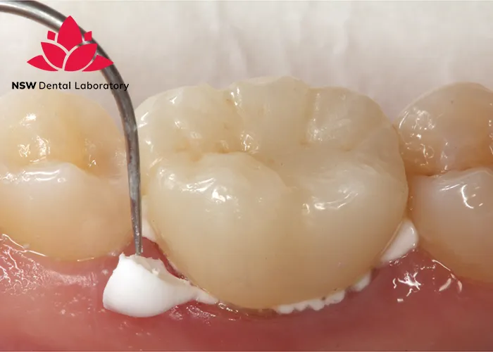 How-To-Achieve-Success-In-Cementing-Zirconia-Crowns?