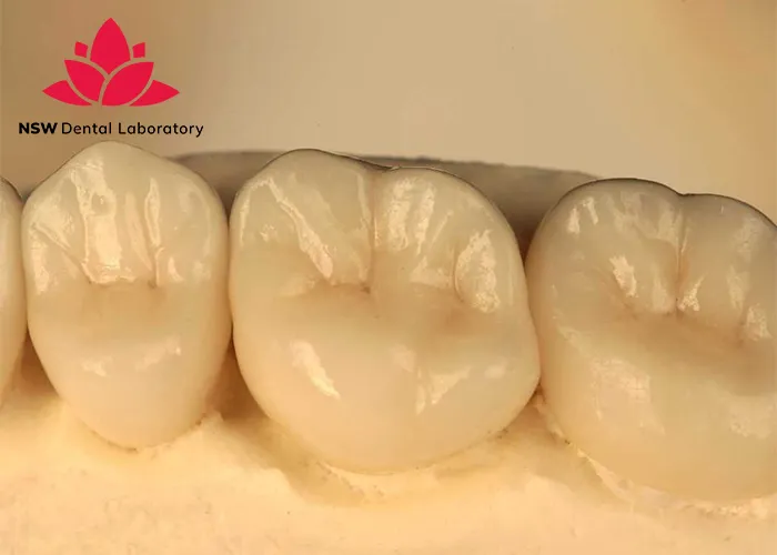 Comprehensive-Guide-About-Ceramic-Crowns-Prosthetics
