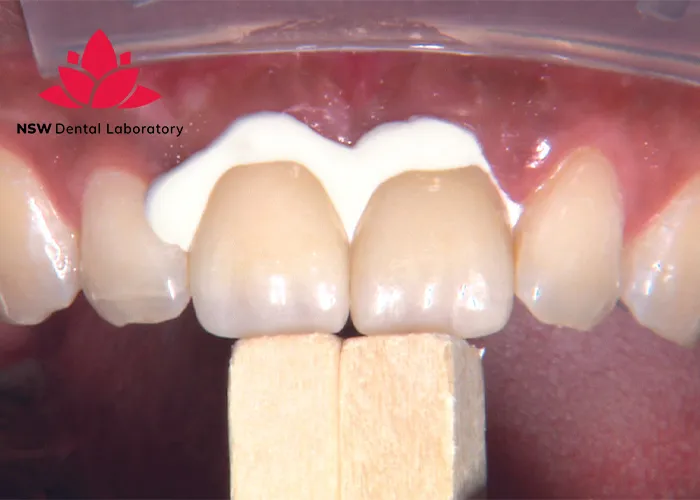 Crown Cementation-Clinical-Guidelines-Tips-and-Best-Practices-for-Success