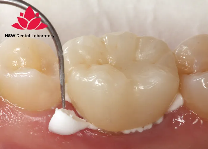 Crown Cementation-Clinical-Guidelines-Tips-and-Best-Practices-for-Success