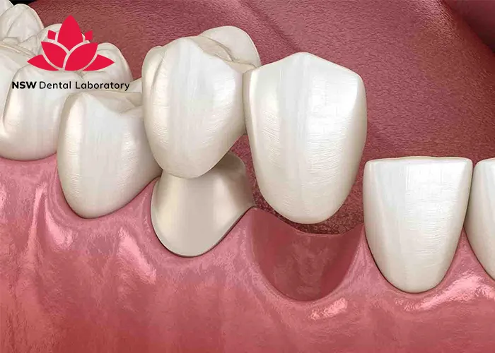 Anterior-Bridge-An-Excellent-Solution-for-Functional-and-Aesthetic-Restoration