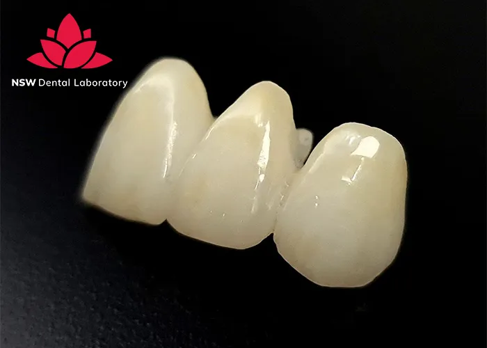 Anterior-Bridge-An-Excellent-Solution-for-Functional-and-Aesthetic-Restoration