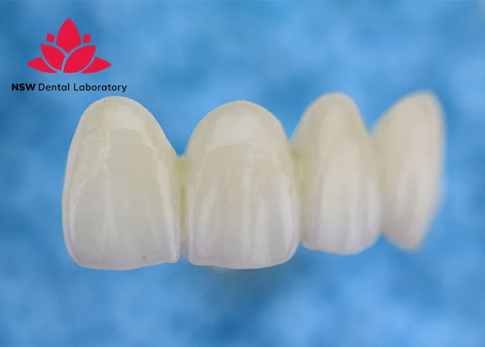 Anterior-Bridge-An-Excellent-Solution-for-Functional-and-Aesthetic-Restoration