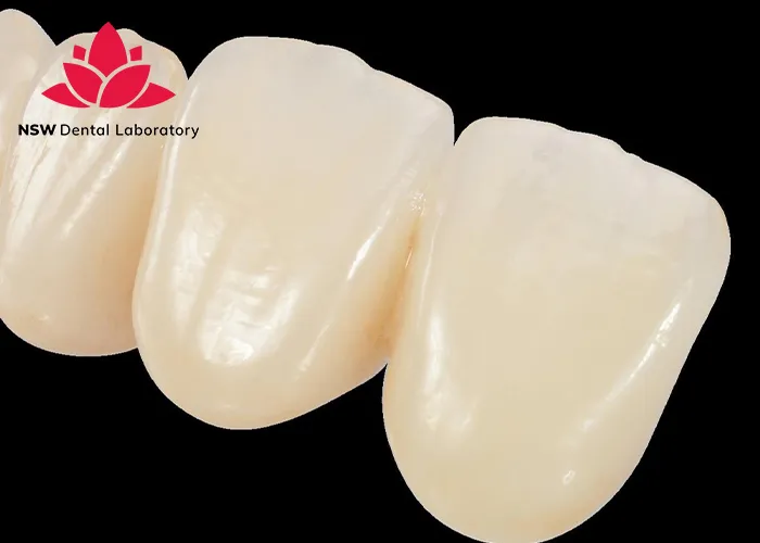 Anterior-Bridge-An-Excellent-Solution-for-Functional-and-Aesthetic-Restoration