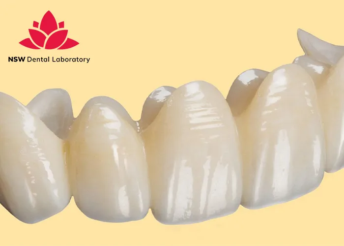 Anterior-Bridge-An-Excellent-Solution-for-Functional-and-Aesthetic-Restoration
