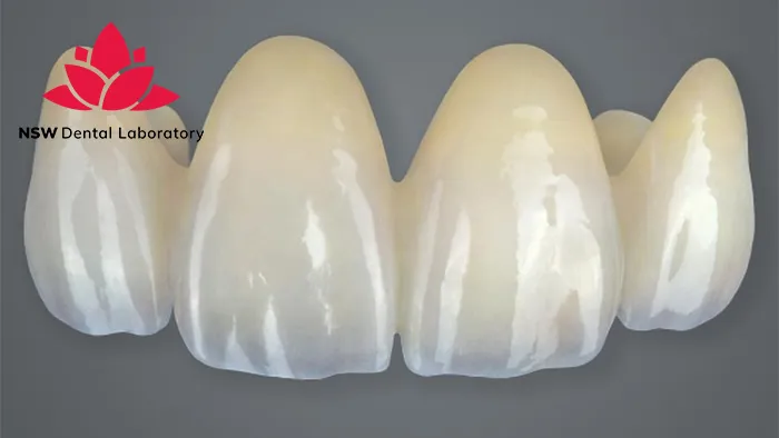 Anterior Bridge: An Excellent Solution for Functional and Aesthetic Restoration