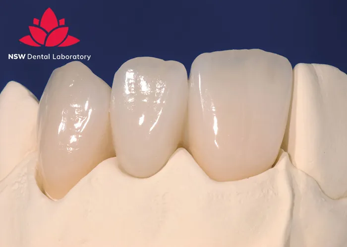 Anterior-Bridge-An-Excellent-Solution-for-Functional-and-Aesthetic-Restoration