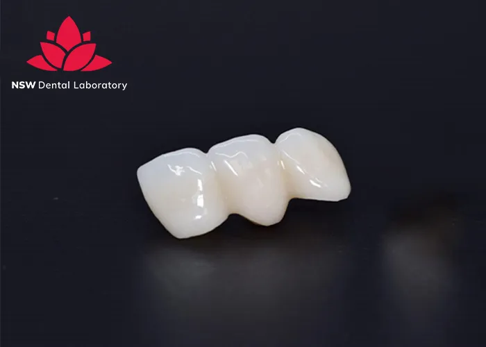 Anterior-Bridge-An-Excellent-Solution-for-Functional-and-Aesthetic-Restoration
