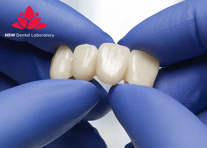 Anterior-Bridge-An-Excellent-Solution-for-Functional-and-Aesthetic-Restoration