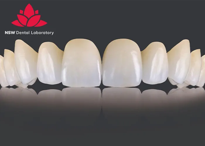 Anterior-Bridge-An-Excellent-Solution-for-Functional-and-Aesthetic-Restoration